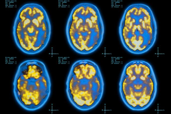 FDA Approves First Drug for Imaging Tau Pathology in Alzheimer’s Disease